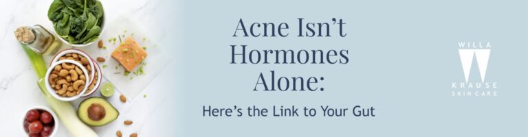 14 7 2025 Blogs Ance isnt Hormones alone Banner | Skin Care
